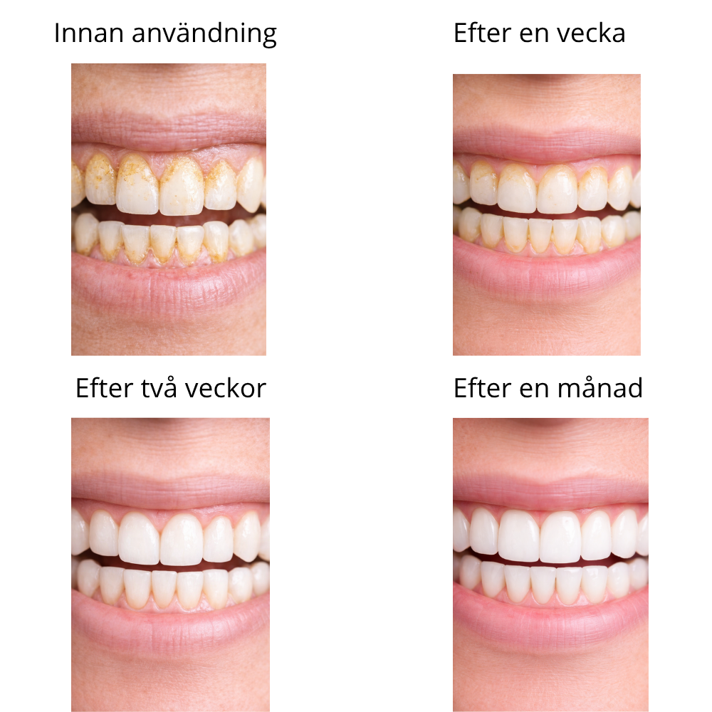 SmilePro™ – Ta Bort Tandsten & Plack Hemma