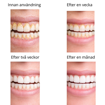 SmilePro™ – Ta Bort Tandsten & Plack Hemma