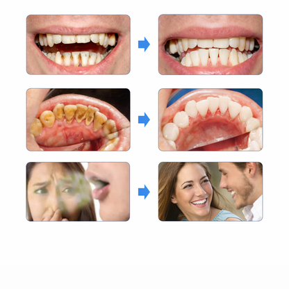 SmilePro™ – Ta Bort Tandsten & Plack Hemma