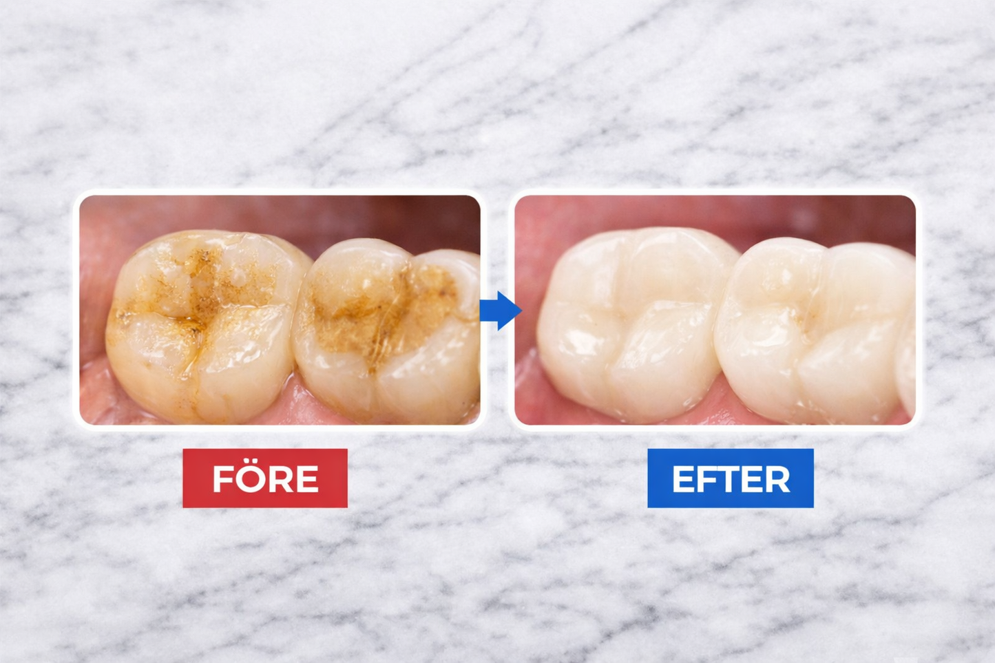 SmilePro™ – Ta Bort Tandsten & Plack Hemma