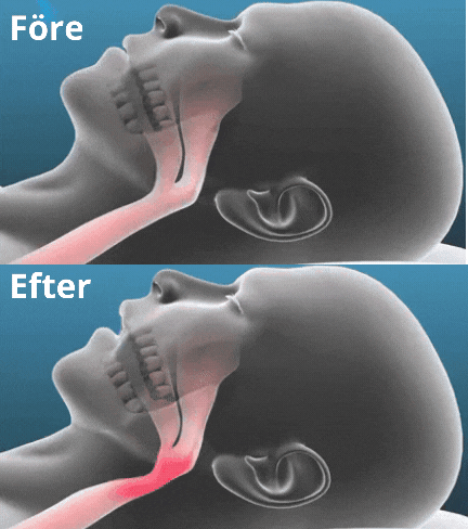 SnoreBlock™ Bettskena mot snarkning