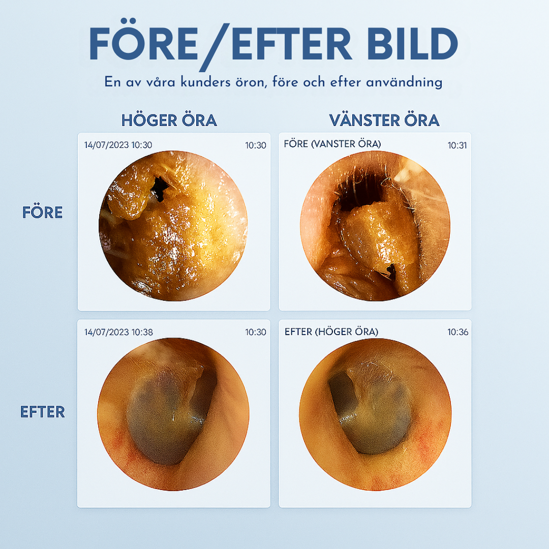 EarVision™ – smart öronrengöring med kamera
