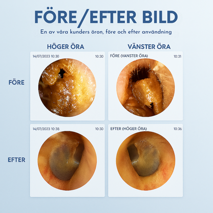 EarVision™ – smart öronrengöring med kamera